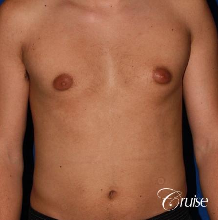 mild gynecomastia before and after with puffy nipple - Before Image 1