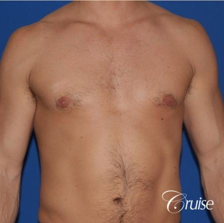 mild gyne on athletic adult - After Image 1