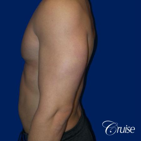 Best before and after gynecomastia pictures - After Image 3