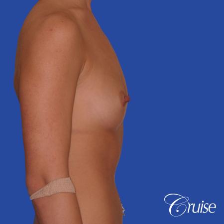 Breast Augmentation - Before Image 3