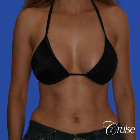 Breast Augmentation - After Image 3