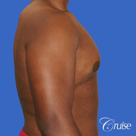 male breast moderate gynecomastia on young teen - After Image 3