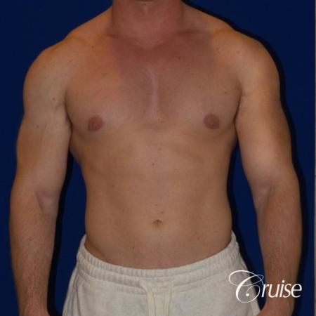 Pictures of young bodybuilder with puffy nipples - After Image 1