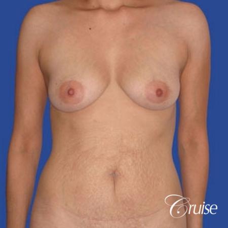 best mommy makeover incisions with saline implants - Before Image 1