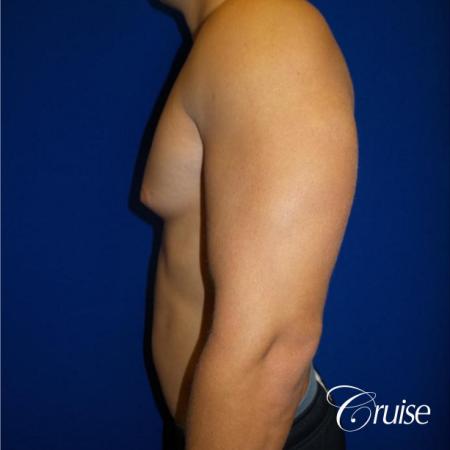 Best before and after gynecomastia pictures - Before and After Image 3