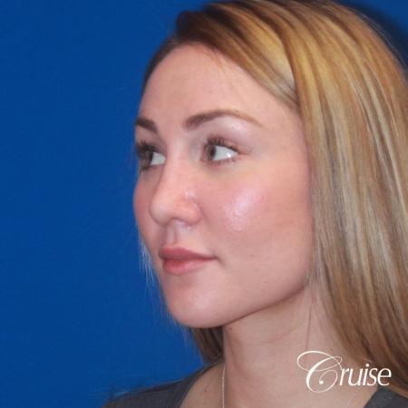 best rhinoplasty with natural results - After Image 2