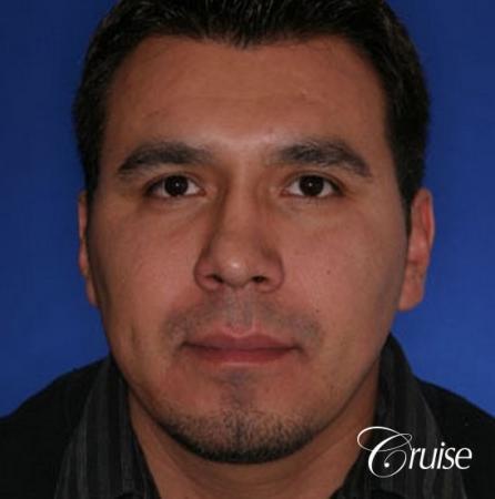 chin augmentation orange county - Before Image 1