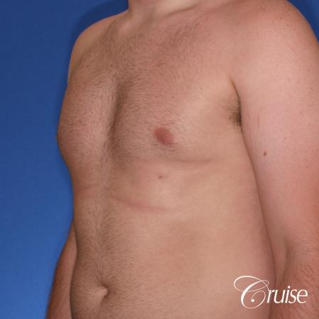 best Puffy nipple correction and gynecomastia on young adult - After Image 3
