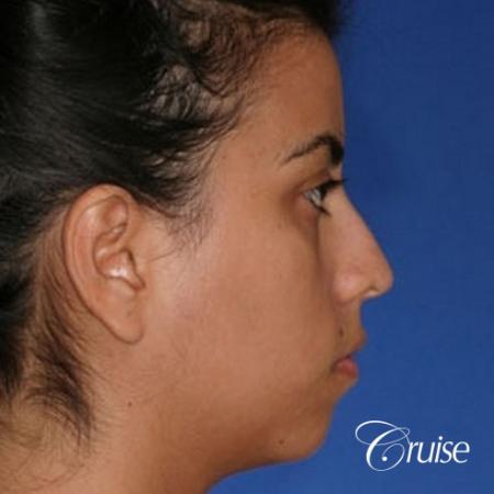 best XL chin implant on female patient - Before Image 4