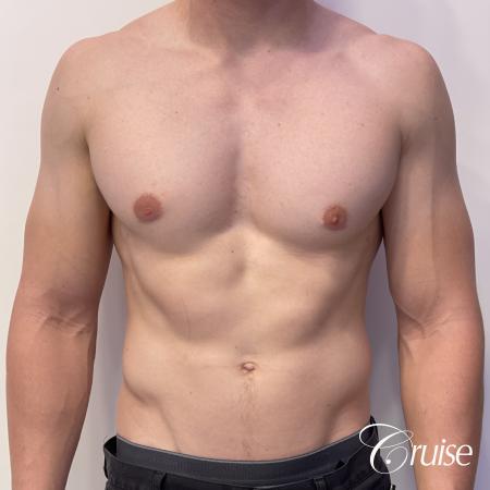 gynecomastia with puffy nipples - After Image 1