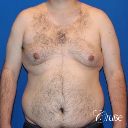 gynecomastia with free nipple graft - Before Image 1