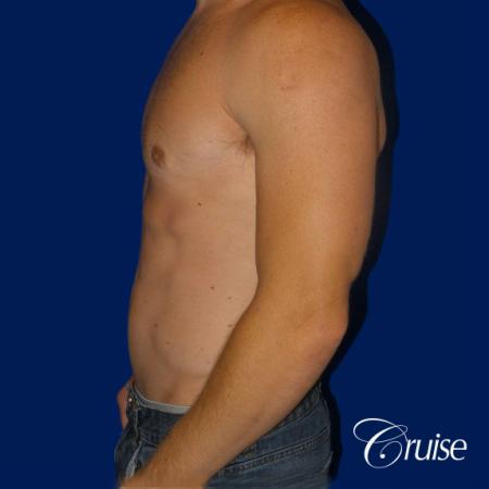 body builder puffy nipple gynecomastia - After 2