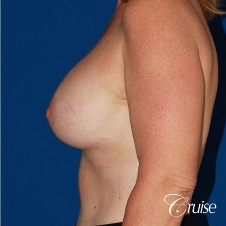 bilateral capsular contracture silicone - After Image 2