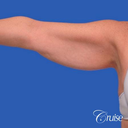 best arm lift newport beach - Before Image 2