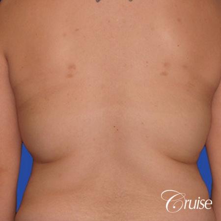 best liposuction pictures of flanks and lipo back - Before Image 1
