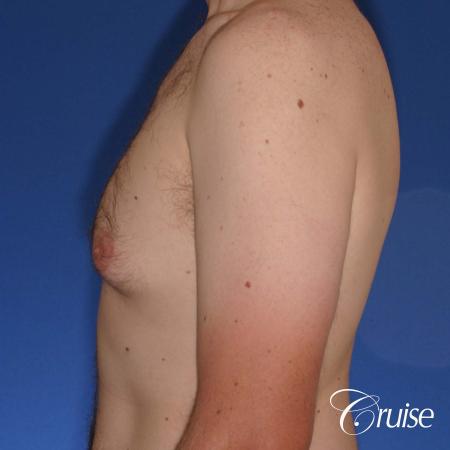 adult male with moderate gynecomastia gets donut lift - Before Image 2