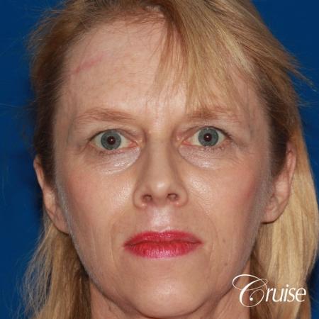 Fat Transfer - Face: Patient 19 - Before Image