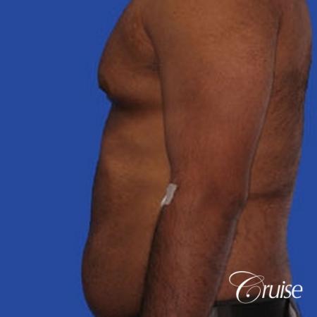 best liposuction abdomen and flanks on a male patient - Before and After Image 3
