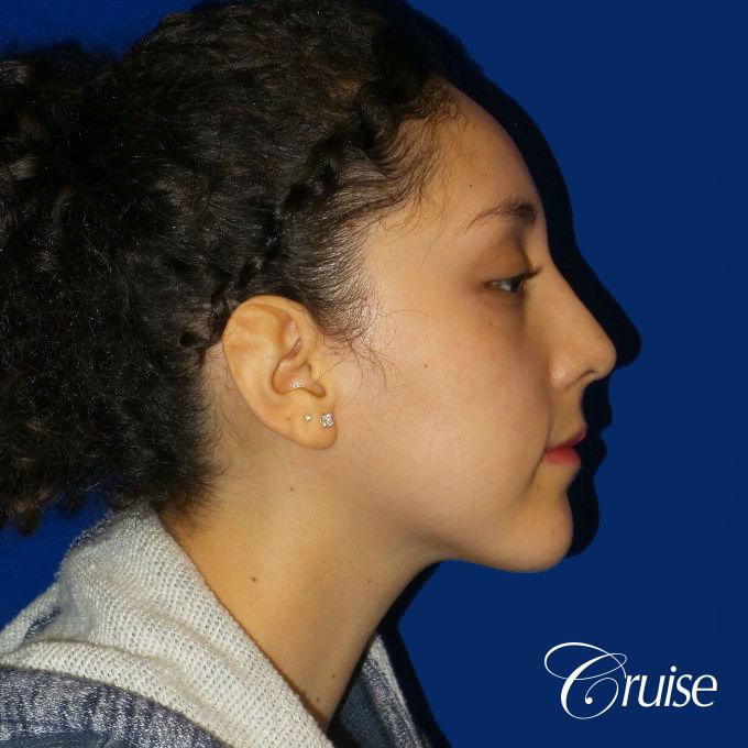 Rhinoplasty - After 3