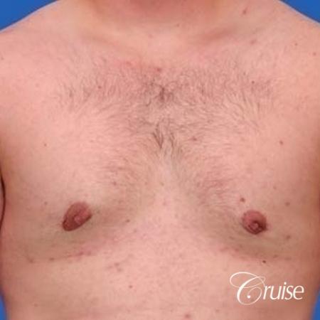 mild gynecomastia with puffy nipple on adult - After Image 1