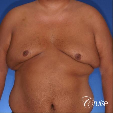 free nipple graft gynecomastia results - Before Image 1