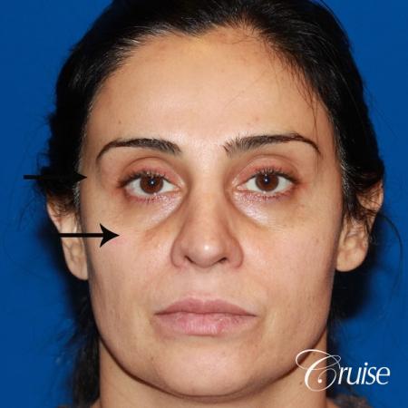 Fat Transfer - Face: Patient 17 - Before Image