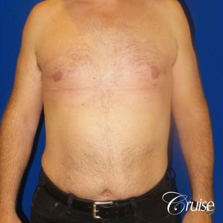gynecomastia surgery results - After Image 1