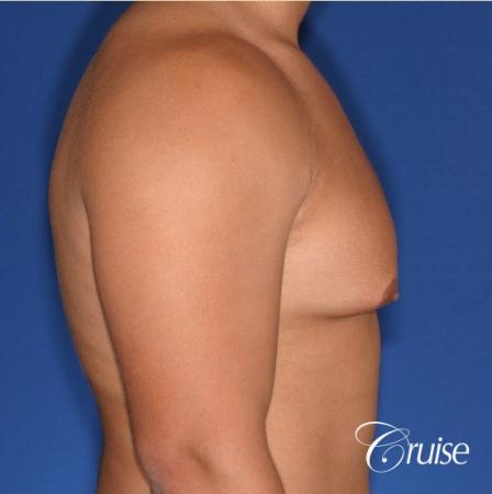 donut lift gynecomastia moderate adult - Before Image 3