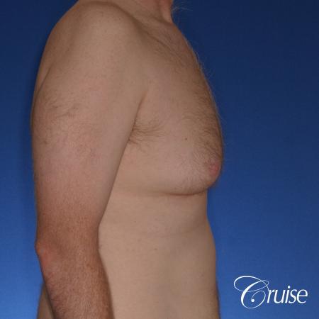 best donut lift with gynecomastia surgery - Before Image 3