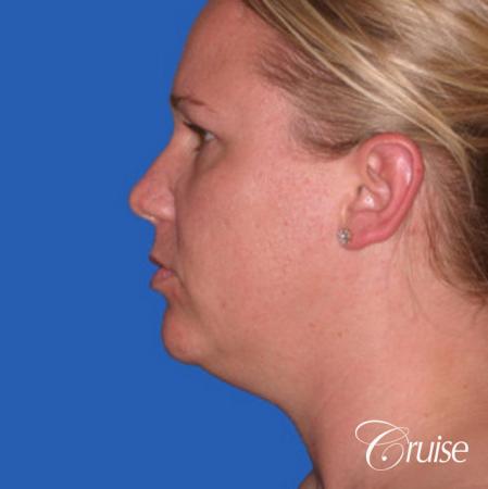 best liposuction neck and jawline for double chin - Before Image 2