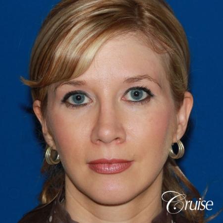 female patient with best chin implant scar - After Image 1