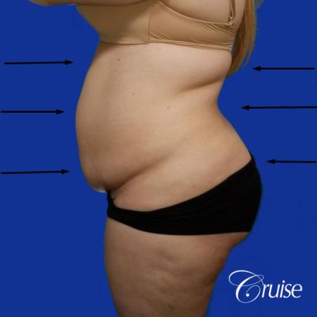 Best liposuction procedures dr cruise - Before Image 2