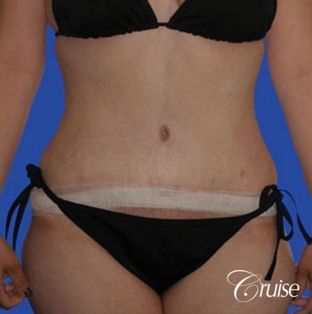 best liposuction tummy tuck - After Image 1