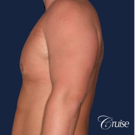 donut lift Gynecomastia correction - Before and After Image 2