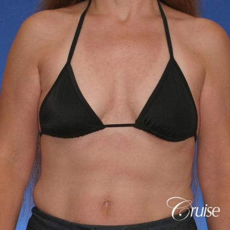 best breast lift donut scars in Newport Beach - Before Image 3