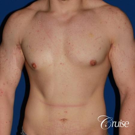 mild-gynecomastia-revision - Before Image 1