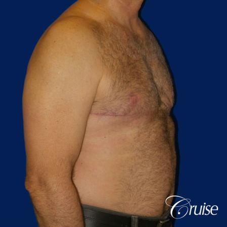 Severe Gynecomastia Correction - After 2