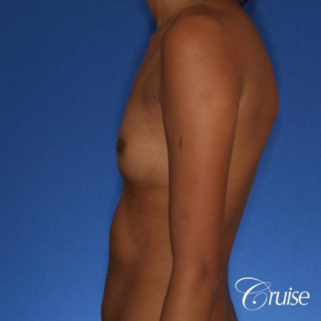 Breast Augmentation - Before Image 2