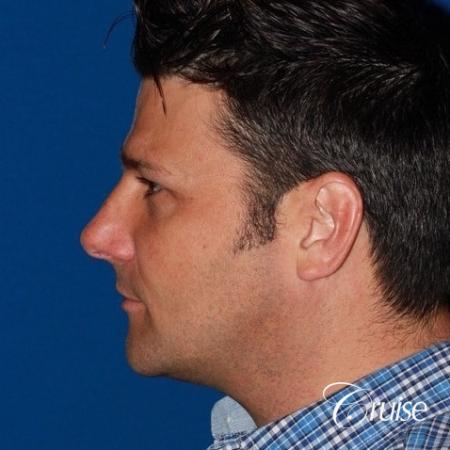 best medium terino square implant before and after pictures - After Image 2