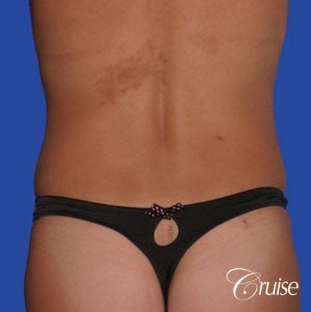 best female lipo results - After Image