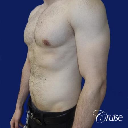 Moderate Gynecomastia -Areola Incision - After Image 3