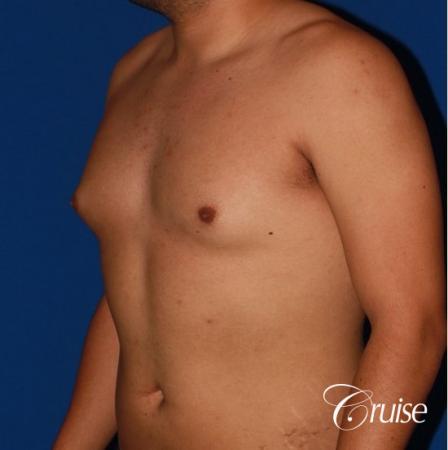 puffy nipple on 26 year old with gynecomastia - Before and After Image 2