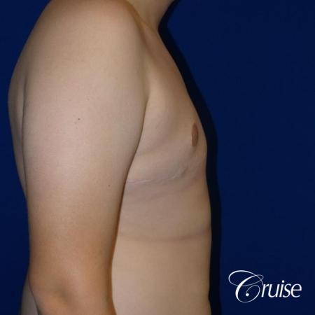 young boy with gynecomastia during puberty gets surgery - After Image 4