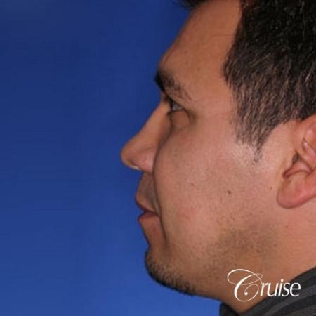 chin augmentation orange county - Before and After Image 2