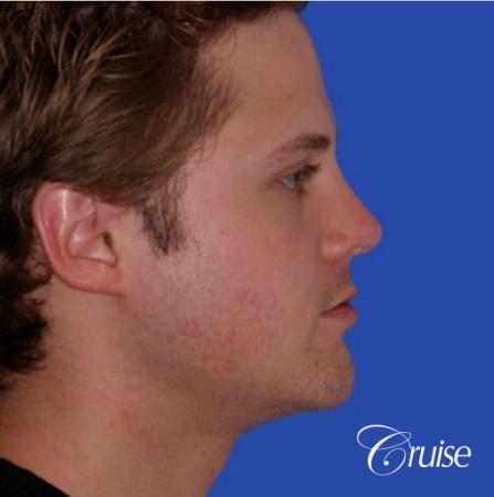 young male with best chin augmentation - After Image 2