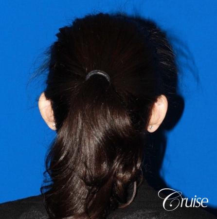 best otoplasty with natural appearance on female - Before and After Image 4