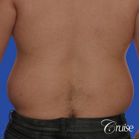male liposuction abdomen flanks with Gynecomastia - Before Image 2