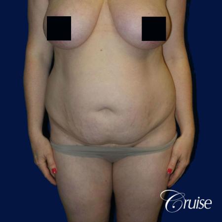 Best tummy tucks dr cruise - Before Image 1