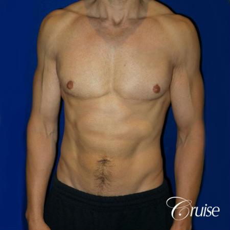 Moderate Gynecomastia -Pedicle - After Image 1