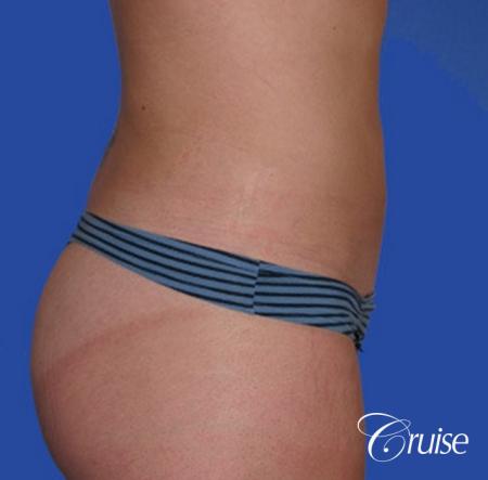 best skinny abs from liposuction abdomen and flanks - After Image 4